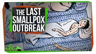 The Last Major Smallpox Outbreak in America [upl. by Mehetabel]