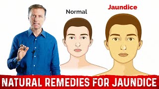 Hemolytic hepatic and obstructive Jaundice explained [upl. by Zulema794]