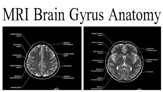 MRI Brain Gyrus Anatomy [upl. by Nbi802]