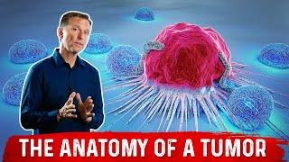 What Causes Tumors Polyps Moles amp Pimples – Dr Berg [upl. by Ahtan]